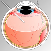 Retina Ameliyatı (Vitrektomi) 1