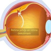 Retina Yırtığı 1